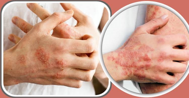 Rog vittik Chikitsha